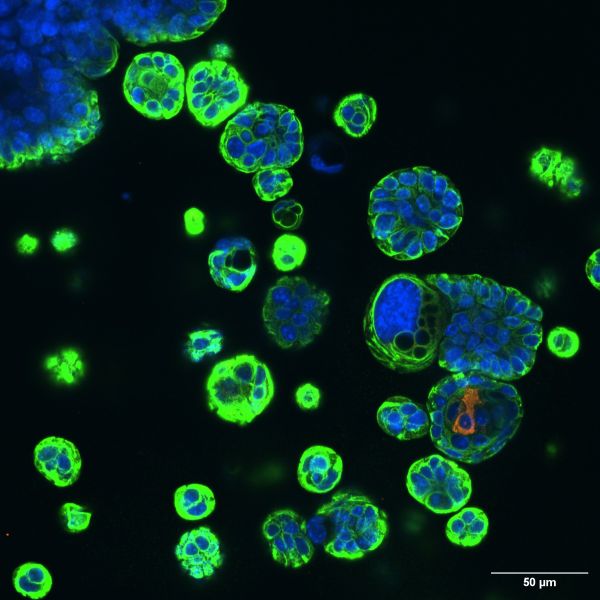 Lung Cancer Cells Of Origin